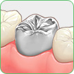 銀歯の被せ物(クラウン)での治療