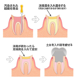 神経の治療をした後、被せ物をする治療