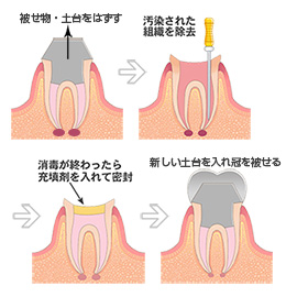 炎症を抑え、神経の治療をした後に、被せ物をする治療